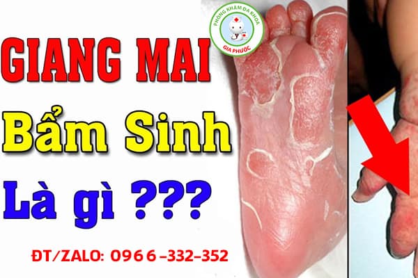 giang mai lây nhiễm cho trẻ sơ sinh