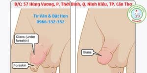 tìm hiểu về bệnh dài bao quy đầu