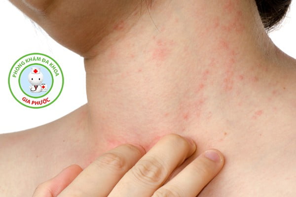 triệu chứng của bệnh giang mai