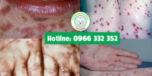 Hình ảnh về giang mai