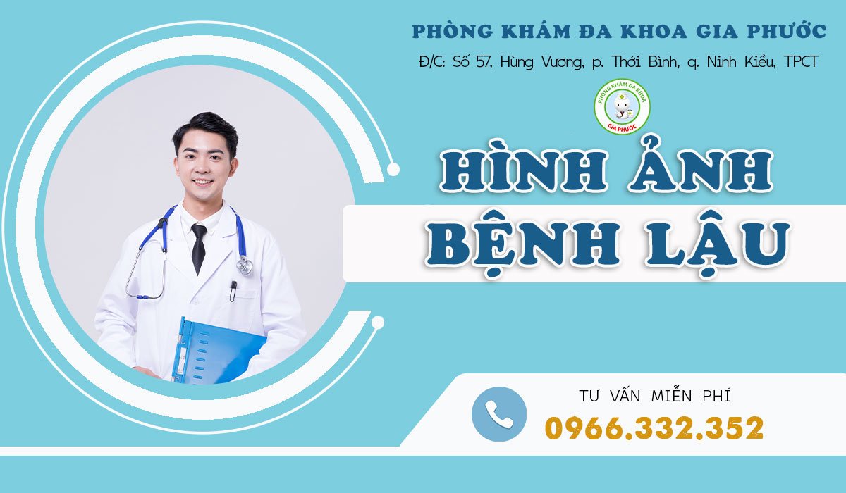 Hình ảnh về bệnh lậu