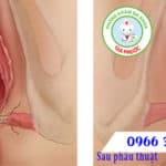 Những lưu ý khi thu nhỏ âm đạo | Phòng khám đa khoa Gia Phước 11 ok 9