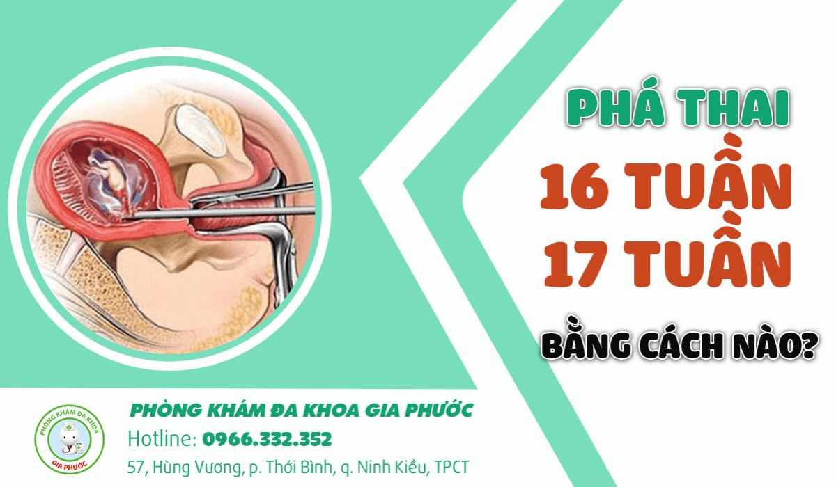 Phá thai lớn từ 12 tuần trở lên bằng phương pháp nào? 12 Cách nào đình chỉ thai 16 tuần và 17 tuần