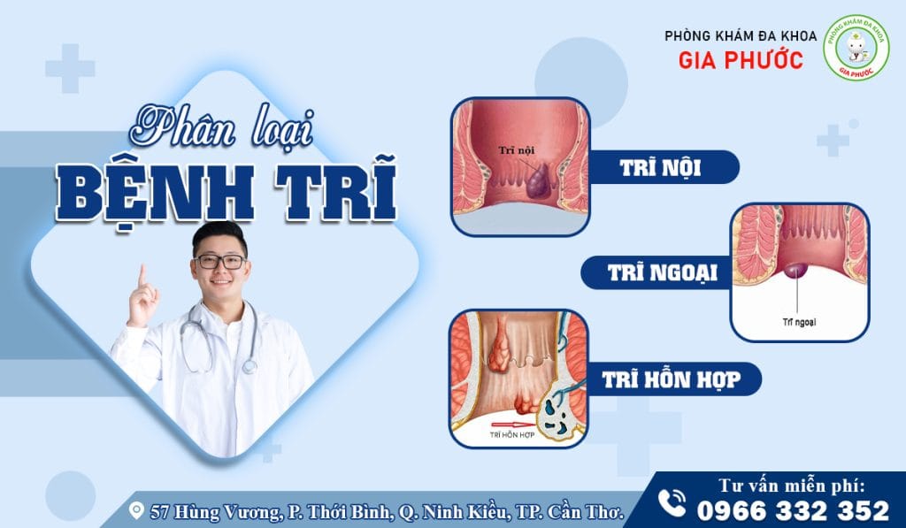 Phân loại bệnh trĩ dựa theo vị trí hình thành búi trĩ