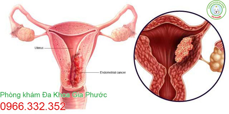 Bệnh Chlamydia có thể gây tắc vòi trứng, ung thư tử cung,..