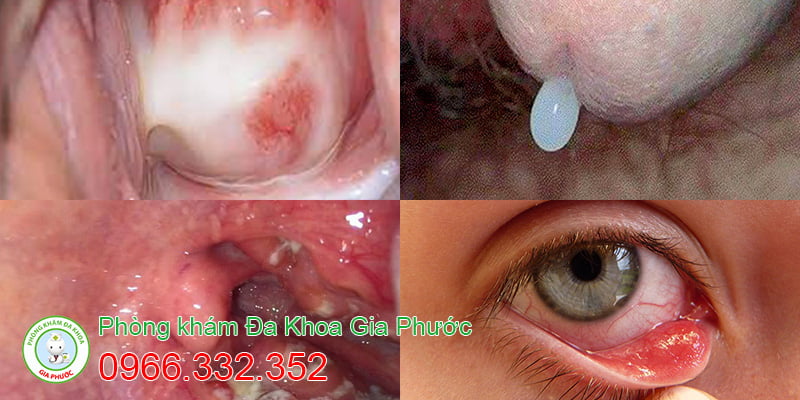 Dấu hiệu mắc bệnh Chlamydia