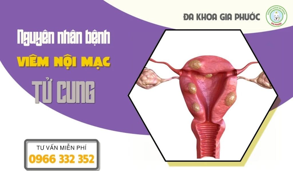 Nguyên nhân viêm nội mạc tử cung ở nữ giới
