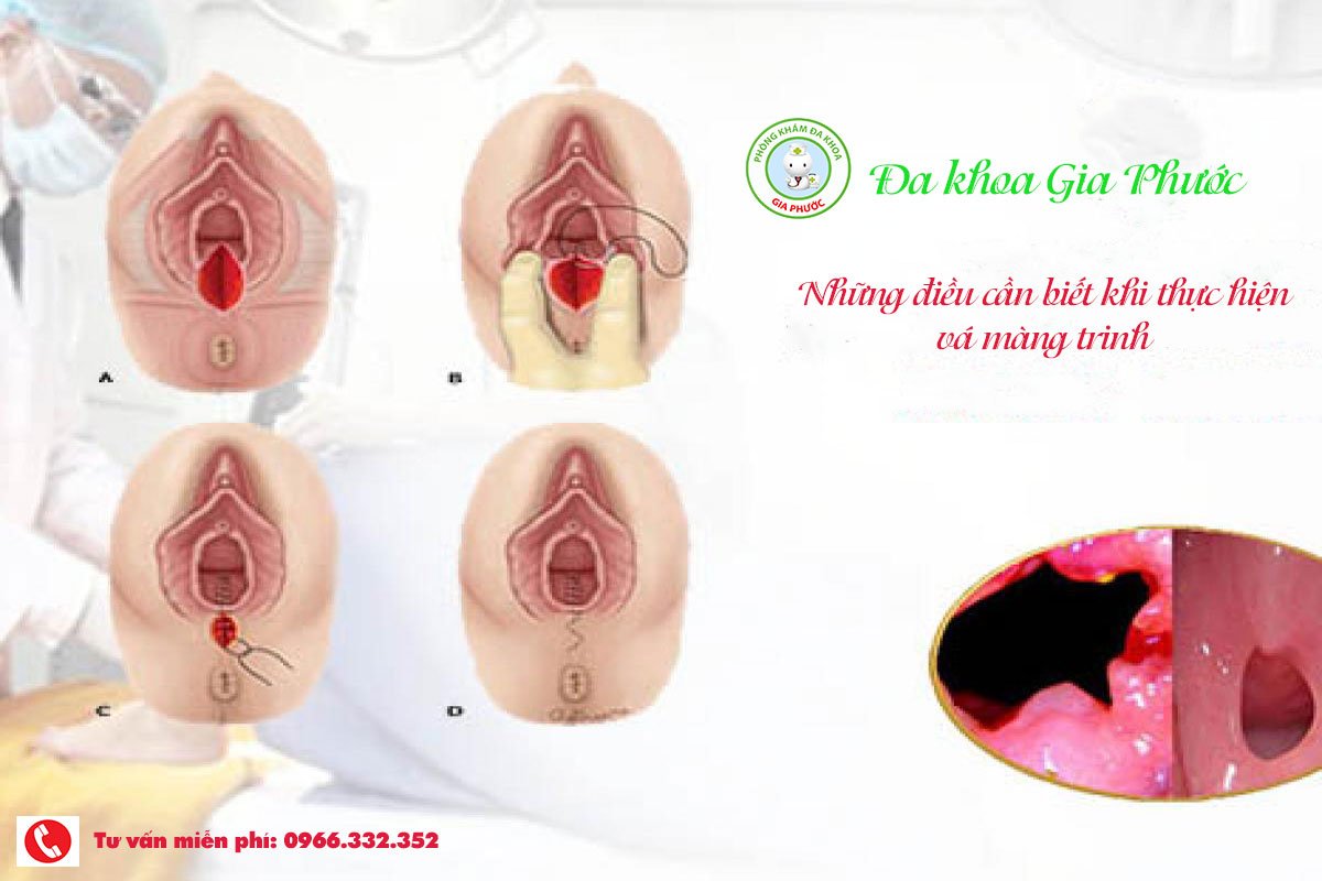 Những điều cần biết khi thực hiện thủ thuật vá màng trinh 3 Những điều cần biết khi thực hiện thủ thuật vá màng trinh