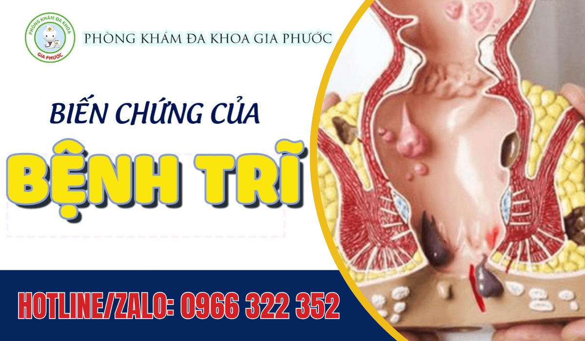 Bệnh viện trị bệnh trĩ ở Cần Thơ nơi nào tốt nhất? 10 Bệnh viện trị bệnh trĩ ở Cần Thơ - Biến chứng của bệnh trĩ rất nguy hiểm nếu không được điều trị kịp thời