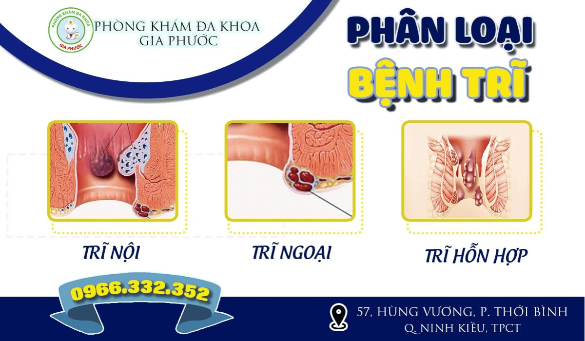 Bệnh viện trị bệnh trĩ ở Cần Thơ nơi nào tốt nhất? 4 Bệnh viện trị bệnh trĩ ở Cần Thơ - Phân loại bệnh trĩ gồm 3 loại: trĩ nội, trĩ ngoại và trĩ hỗn hợp