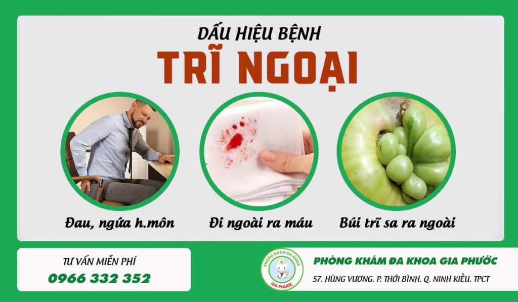 Dấu hiệu bệnh trĩ ngoại dễ nhận biết 