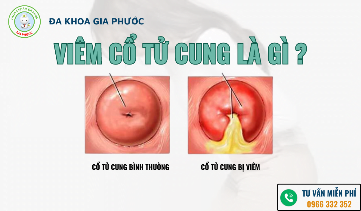Chi phí điều trị viêm cổ tử cung? Viêm cổ tử cung là gì?
