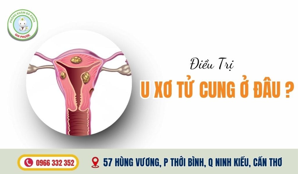 Điều Trị U Xơ Tử Cung Ở Đâu