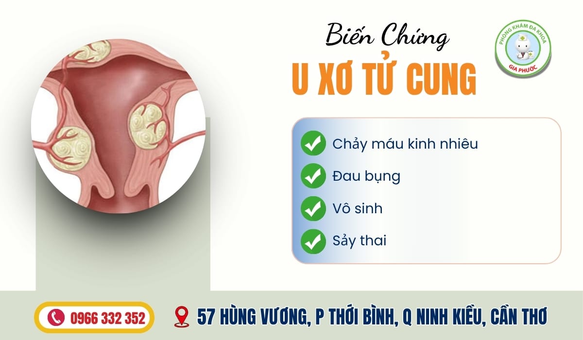 Điều Trị U Xơ Tử Cung Ở Đâu Biến chứng u xơ tử cung
