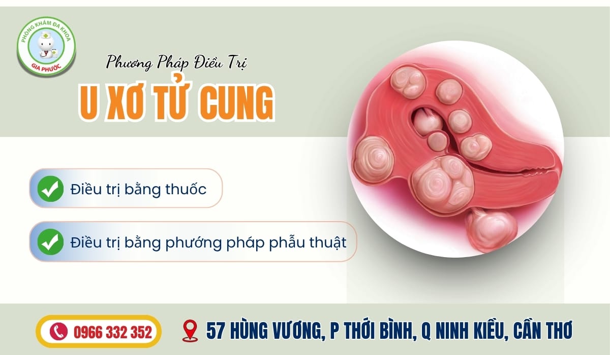 Điều Trị U Xơ Tử Cung Ở Đâu Phương pháp điều trị u xơ tử cung