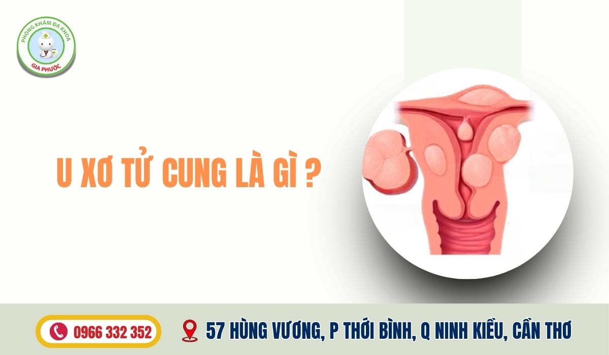 Điều Trị U Xơ Tử Cung Ở Đâu U xơ tử cung là gì