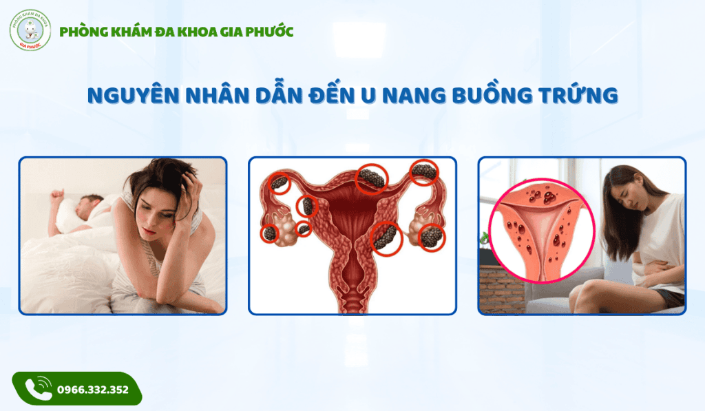 Điều trị u nang buồng trứng tại cần thơ