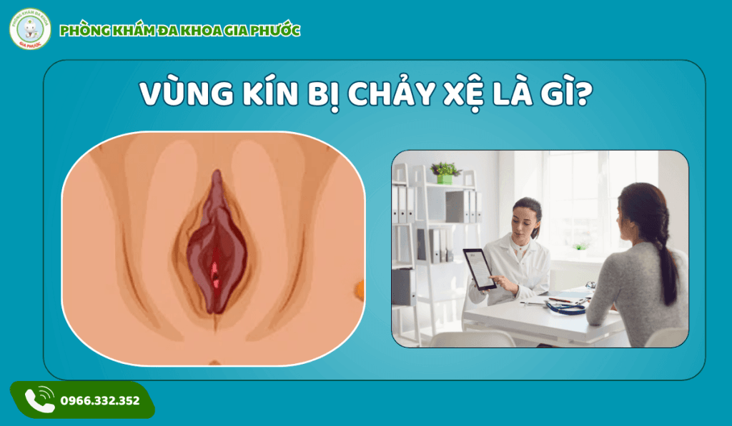 Điều Trị Vùng Kín Bị Chảy Xệ Tại Cần Thơ: Giải Pháp Cho Sự Tự Tin Và Hạnh Phúc 2 Điều trị vùng kín bị chảy xệ tại cần thơ