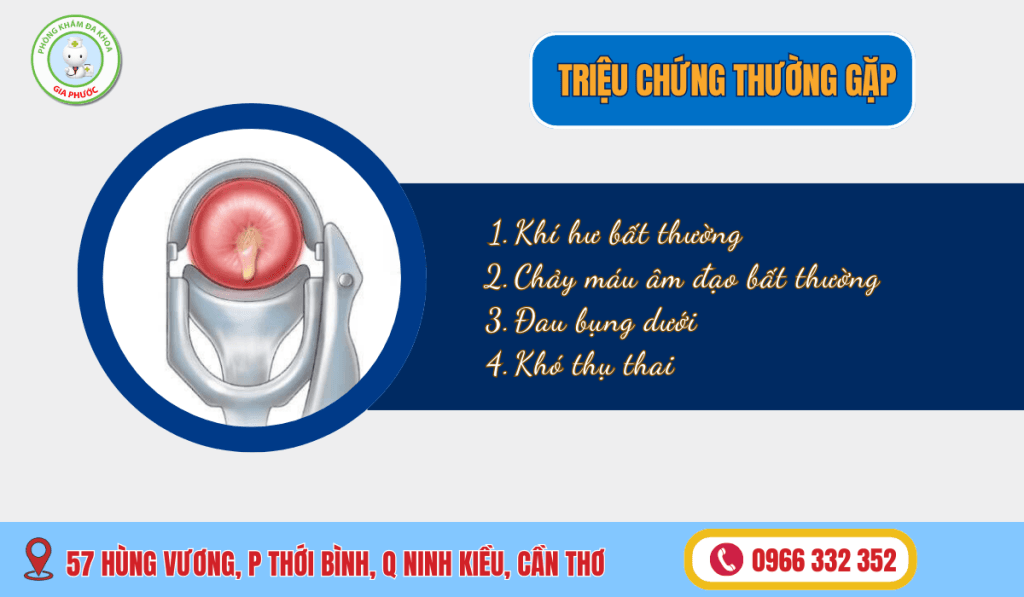 Hiểu rõ về Polyp Cổ Tử Cung Không đơn giản như bạn nghĩ