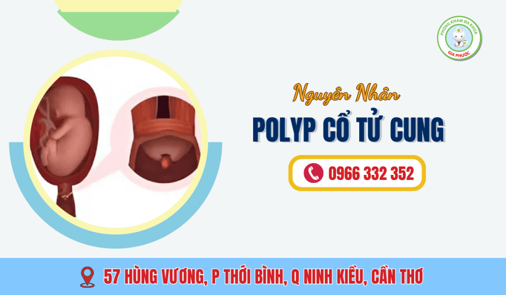 Nguyên Nhân Polyp Cổ Tử Cung