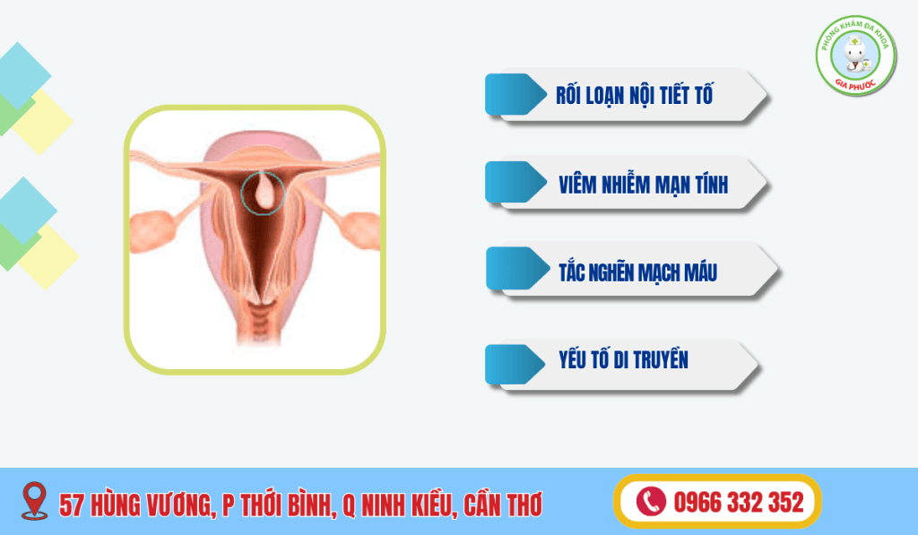 Nguyên Nhân Polyp Cổ Tử Cung - Điểm Danh Các Nguyên Nhân Polyp Cổ Tử Cung 