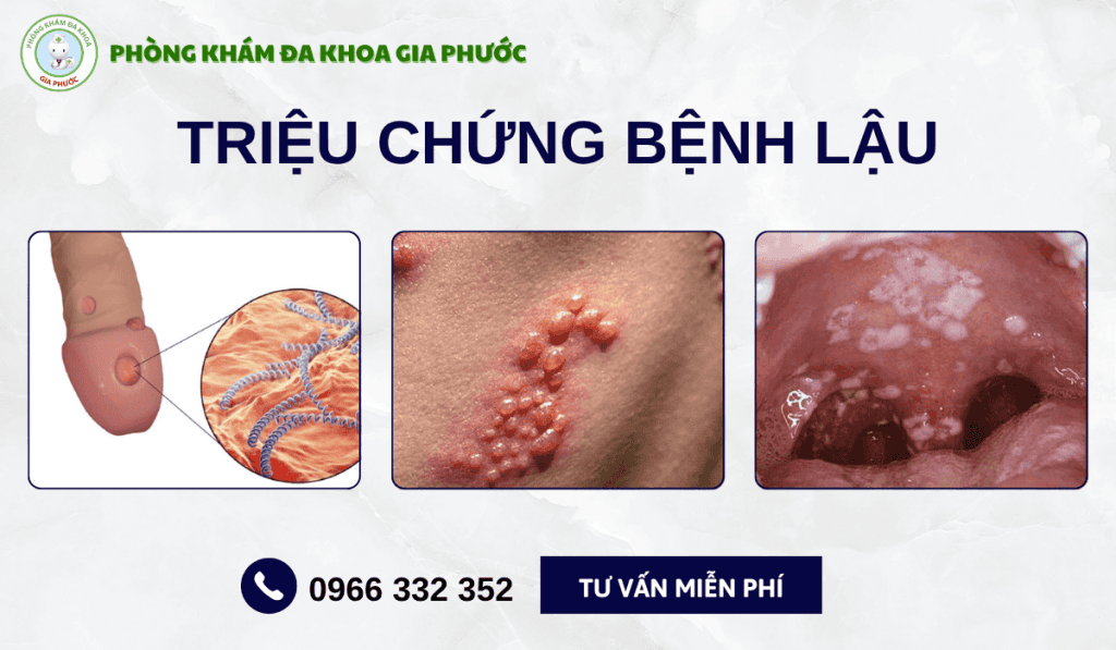 Bệnh Lậu: Nguyên Nhân Và Triệu Chứng 7 Bệnh lậu