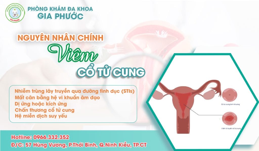 nguyên nhân chính dẫn đến viêm cổ tử cung