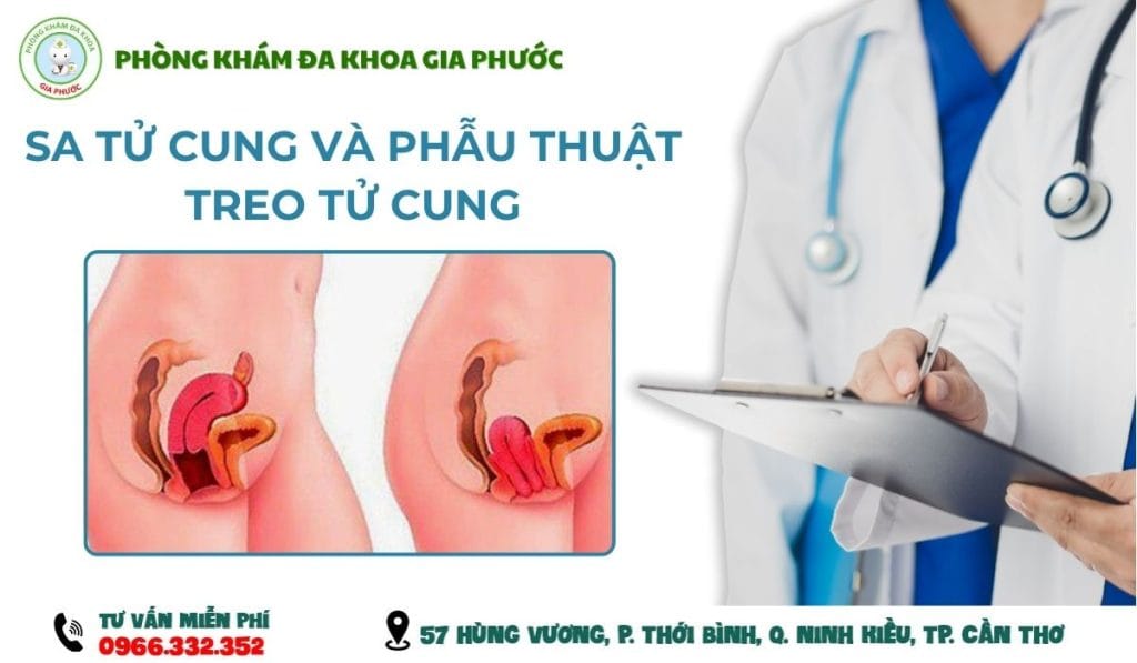 Chi phí phẫu thuật sa tử cung
