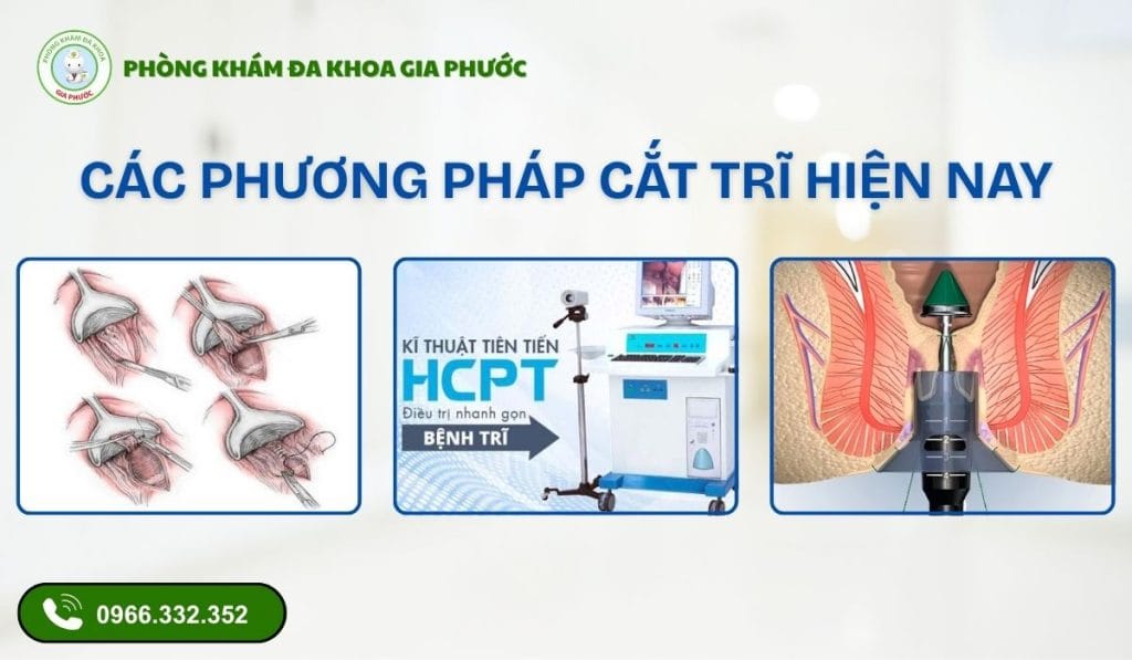 Phẫu thuật cắt trĩ ở đâu uy tín