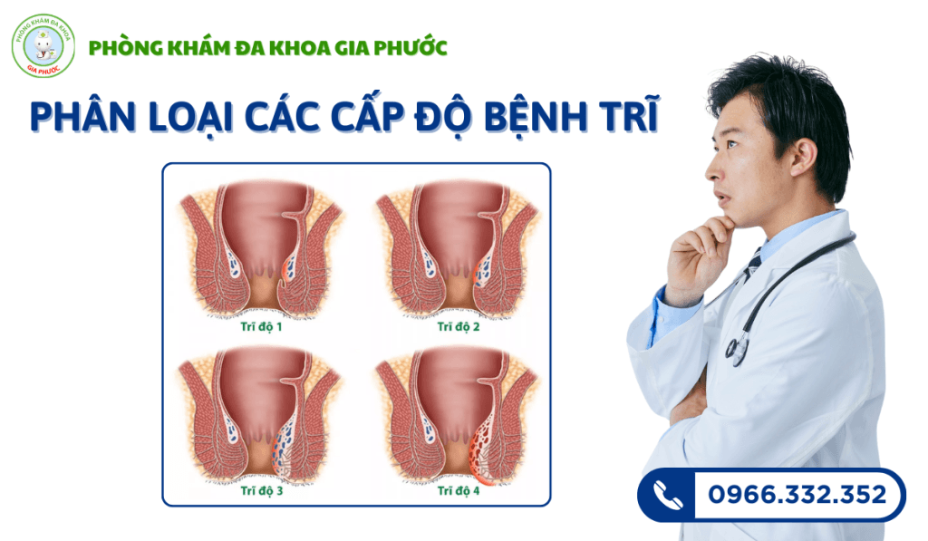 Chi phí cắt trĩ ở cà mau là bao nhiêu