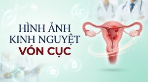 Hình ảnh kinh nguyệt vón cục