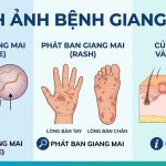 Hình ảnh bệnh giang mai