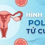 Hình ảnh polyp tử cung