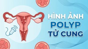 Hình ảnh polyp tử cung