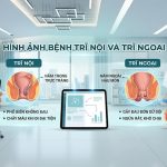 Hình ảnh bệnh trĩ nội và trĩ ngoại 4 cấp độ