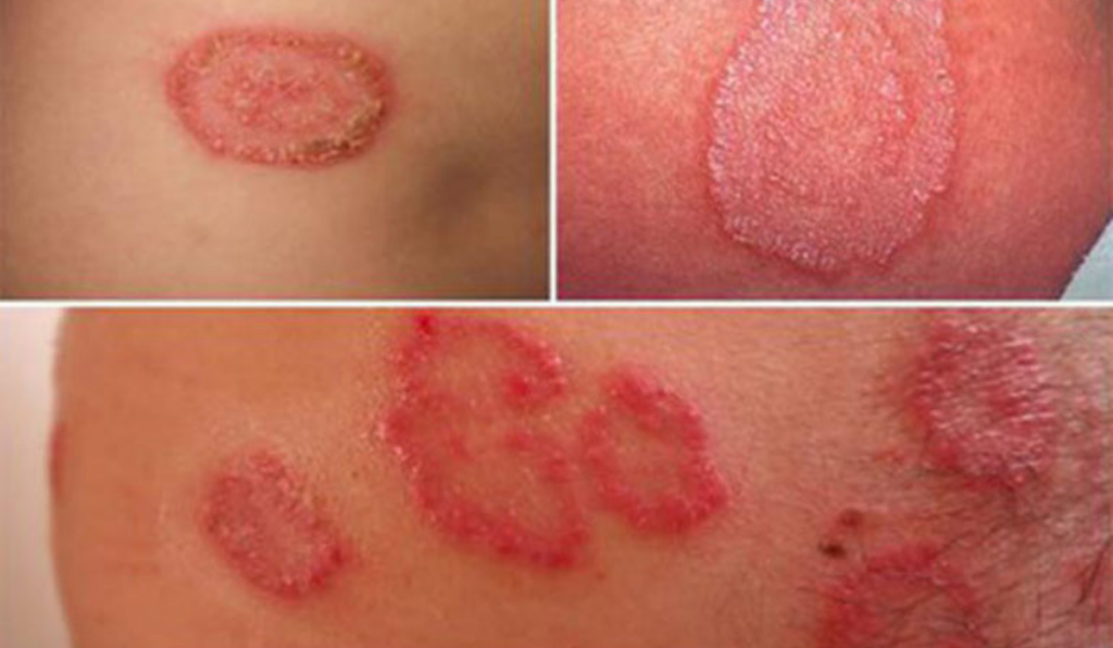 STD/STI là gì? Cách Phân Biệt Và Tìm Hiểu Tất Cả Bệnh Xã Hội Chi Tiết 9 Hình ảnh bệnh lậu
