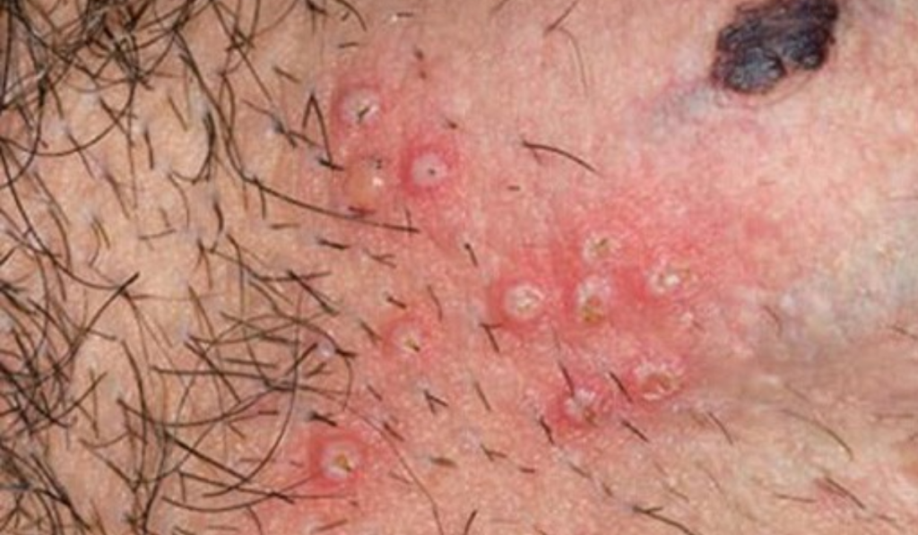 STD/STI là gì? Cách Phân Biệt Và Tìm Hiểu Tất Cả Bệnh Xã Hội Chi Tiết 8 Hình ảnh bệnh mụn rộp sinh dục