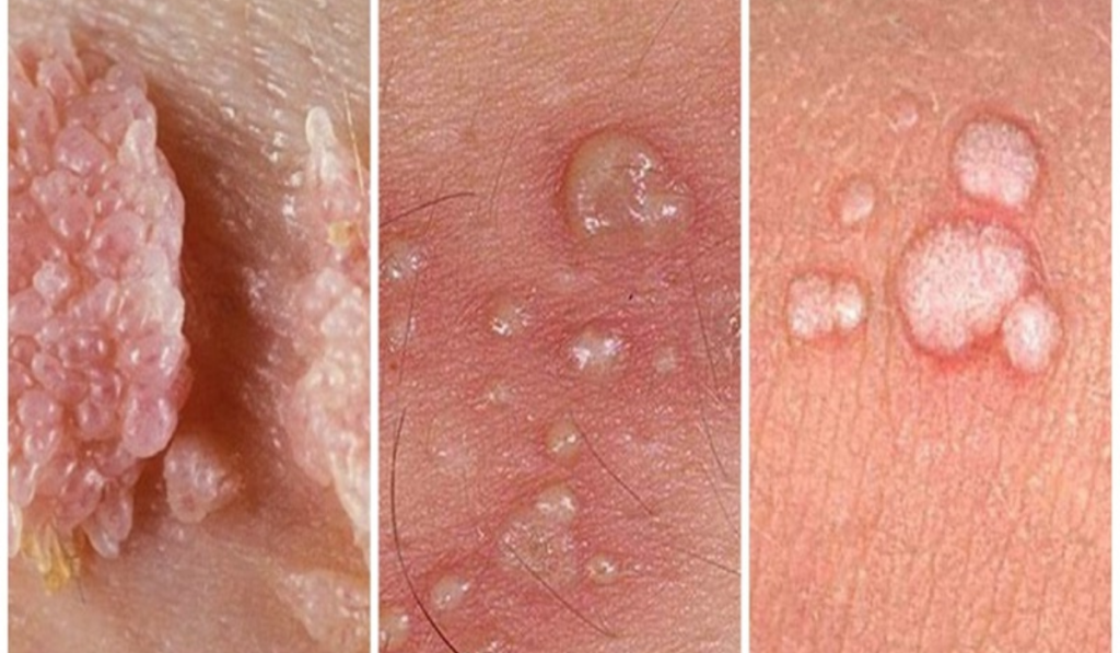 STD/STI là gì? Cách Phân Biệt Và Tìm Hiểu Tất Cả Bệnh Xã Hội Chi Tiết 7 Hình ảnh bệnh sùi mào gà
