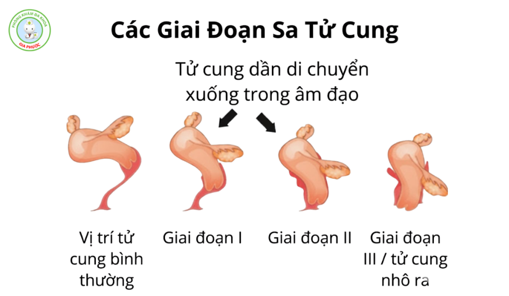 Các giai đoạn sa tử cung