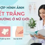 Hình ảnh huyết trắng bình thường ở nữ
