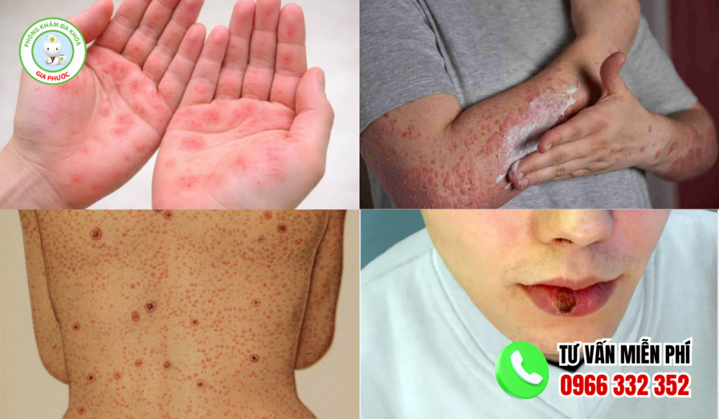 Hình Ảnh Bệnh Giang Mai Qua Từng Giai Đoạn Ở Nam Và Nữ 3 Hình ảnh bệnh giang mai