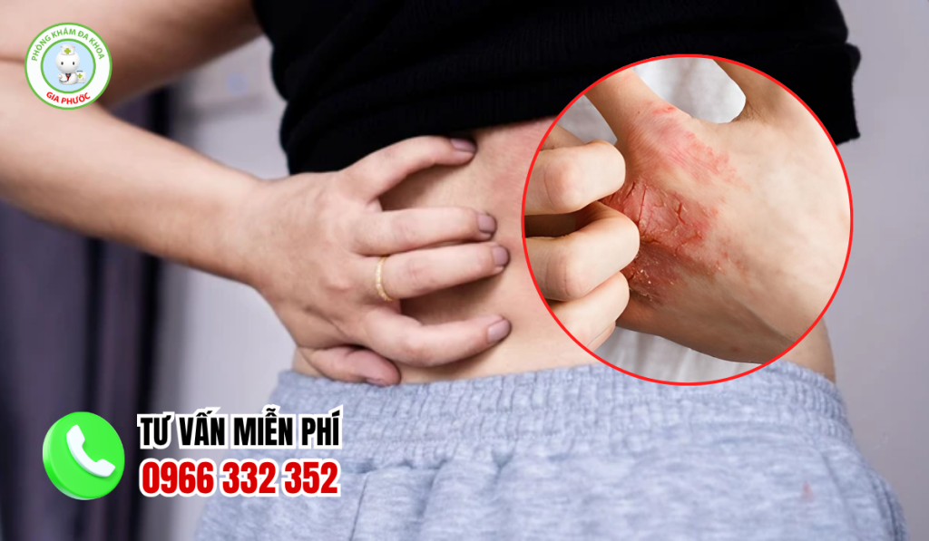 Hình Ảnh Bệnh Giang Mai Qua Từng Giai Đoạn Ở Nam Và Nữ 2 hình ảnh bệnh giang mai