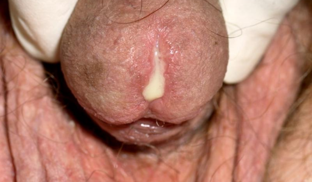 Hình ảnh bệnh lậu ở nam