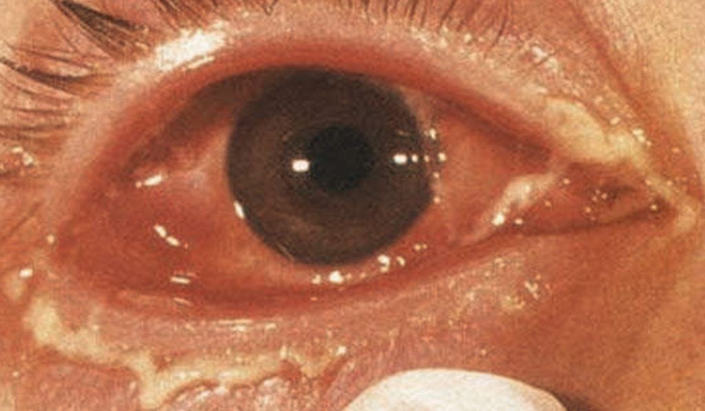 Hình ảnh bệnh lậu ở mắt
