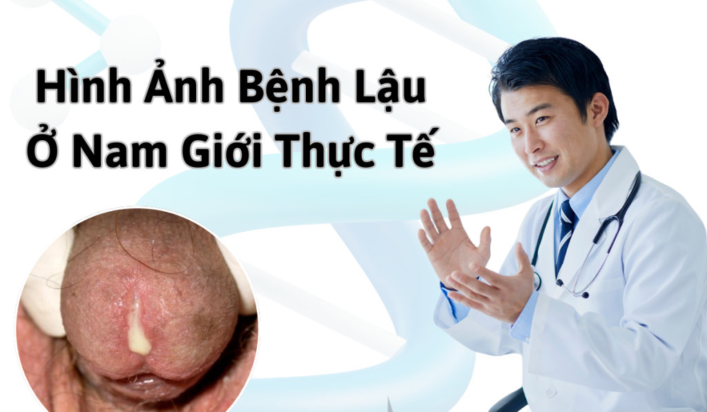 Hình ảnh bệnh lậu ở nam và nữ