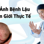 Hình ảnh bệnh lậu ở nam và nữ