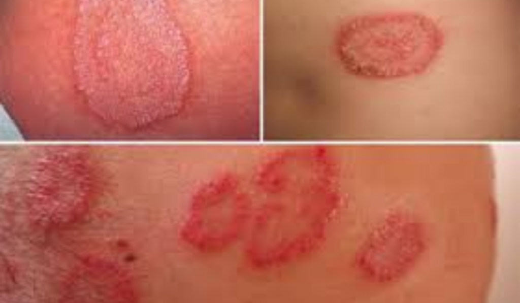 Hình ảnh bệnh lậu ở nam giai đoạn mãn tính