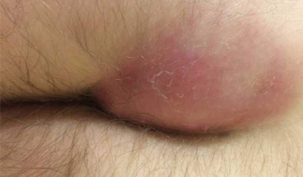 Hình ảnh bệnh lậu ở nam và nữ 