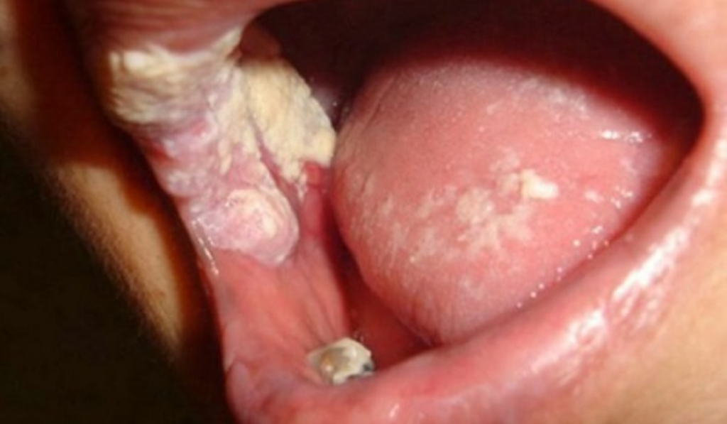 Hình ảnh bệnh lậu ở nam và nữ