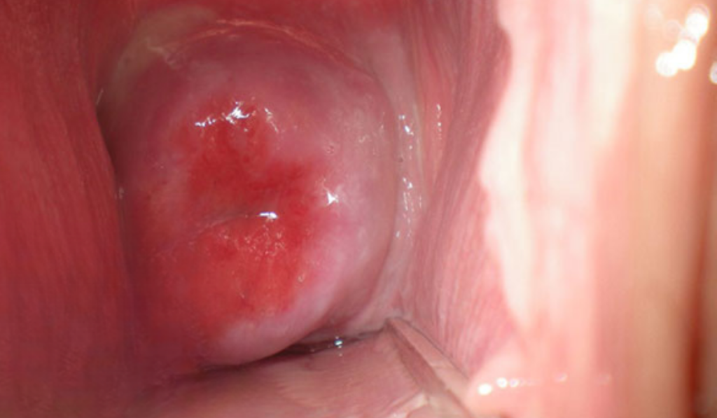 Hình ảnh bệnh lậu ở nữ